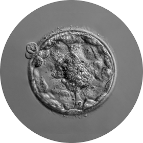 레이저 보조부화술